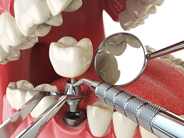 Best Emergency Wisdom Tooth Extraction in Crestwood Village, NJ